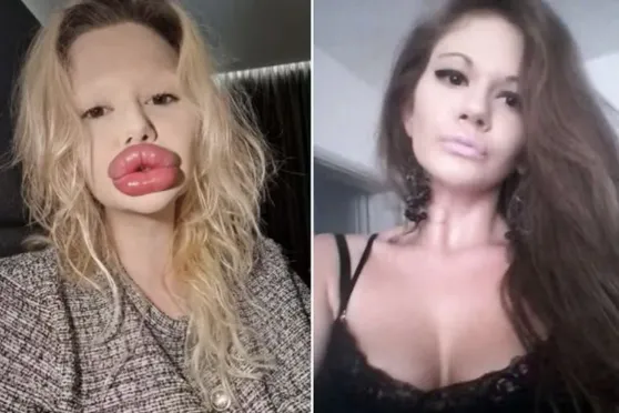 Mulher com maiores lábios do mundo antes e depois Andrea Ivanova
